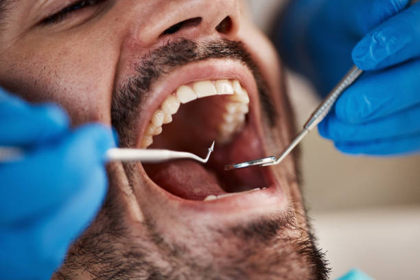 Dental Inlays and Onlays in Hondo, TX